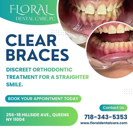 Straighten your smile with confidence 😁✨