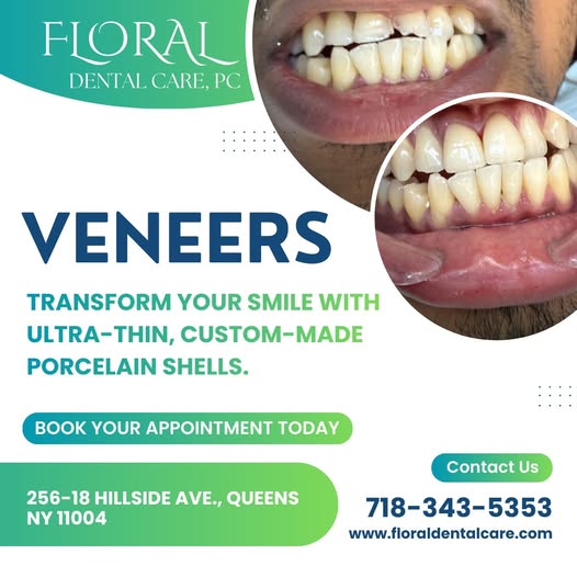Veneers: Transform Your Smile with a Natural, Confident Look