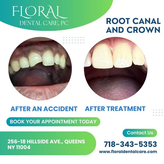 Root Canal and Crown Treatment After a Dental Accident